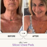 Silicon Pads for Chest Wrinkles 2pads - SkinRèmide